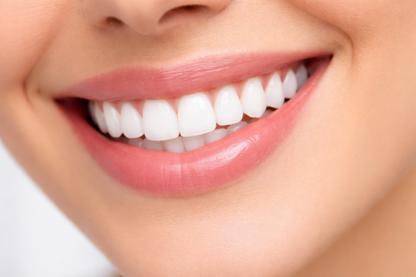 Blanqueamiento dental en Burjassot